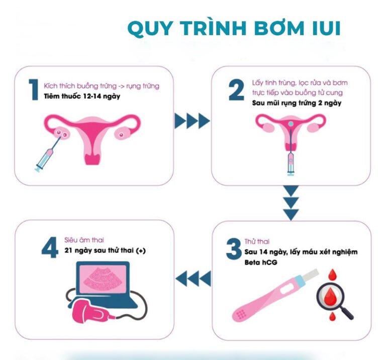 Cách Làm IUI: Quy Trình Và Chi Phí Thực Hiện Chi Tiết 2025