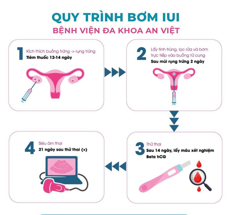 các bước làm thụ tinh nhân tạo, tiến hành thụ tinh nhân tạo IUI