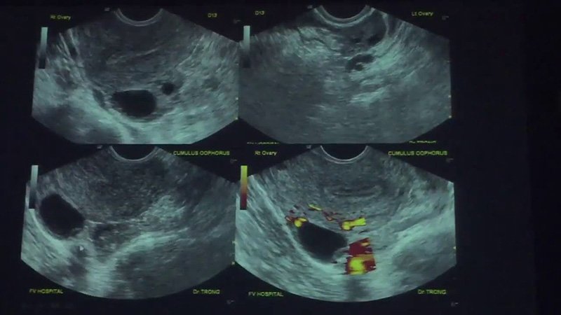 quy trình thụ tinh, kích thích buồng trứng trong thụ tinh nhân tạo