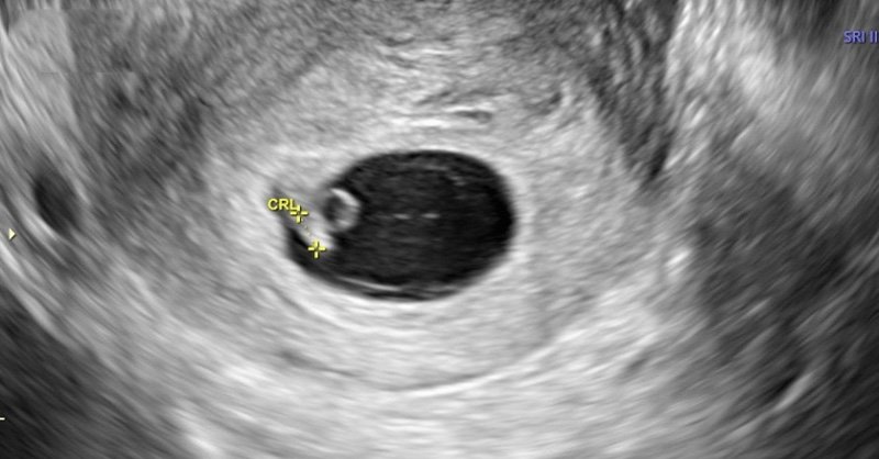 quy trình thụ tinh, theo dõi sau thụ tinh nhân tạo